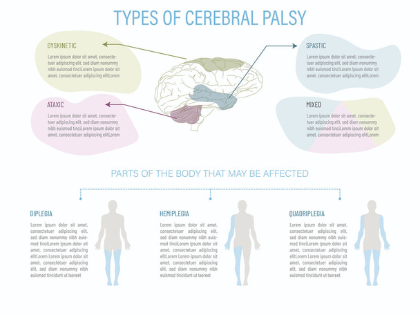 World Cerebral Palsy Day.infographic met een brein en de delen beïnvloed door de verschillende soorten verlamming, alsmede welk deel van het lichaam wordt beïnvloed door elk type. - Vector, afbeelding