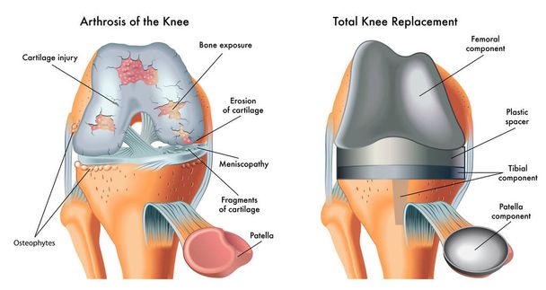 A ilustração médica mostra artrose do joelho e substituição total do joelho, com anotações. - Vetor, Imagem
