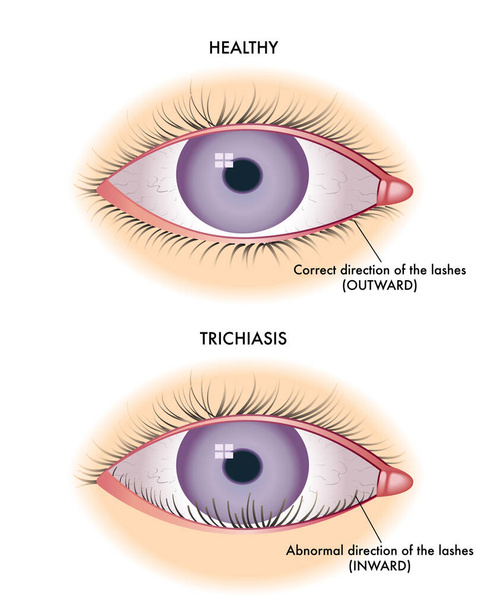 Medizinische Illustration, die einen Vergleich zwischen einem normalen und einem von Trichiasis betroffenen Auge zeigt. - Vektor, Bild