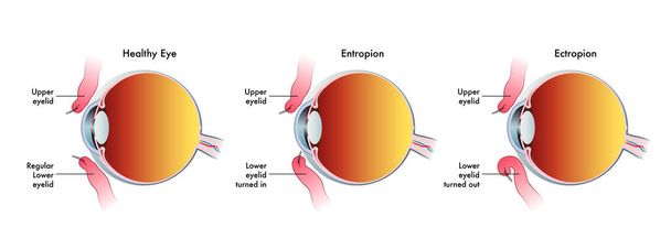 orvosi illusztráció, amely összehasonlítja az entropium által érintett normál szemet az ektropium által érintett másik szemével. - Vektor, kép