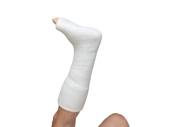 Žena se zlomenou nohou. noha v sádře na izolovaném bílém pozadí. Zavřít - Fotografie, Obrázek