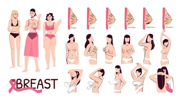 Conjunto plano de mujer de mama con secciones transversales de anatomía mamaria femenina normal y enferma ilustración vectorial aislada - Vector, imagen
