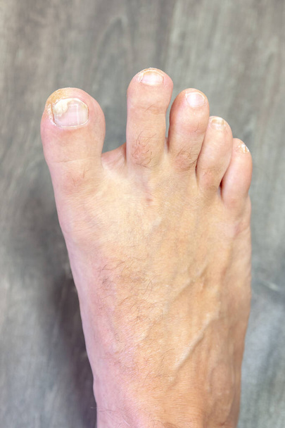 Enfermedad dermatológica que afecta las uñas de los pies causada por un hongo. Enfoque selectivo con profundidad de campo poco profunda. - Foto, imagen