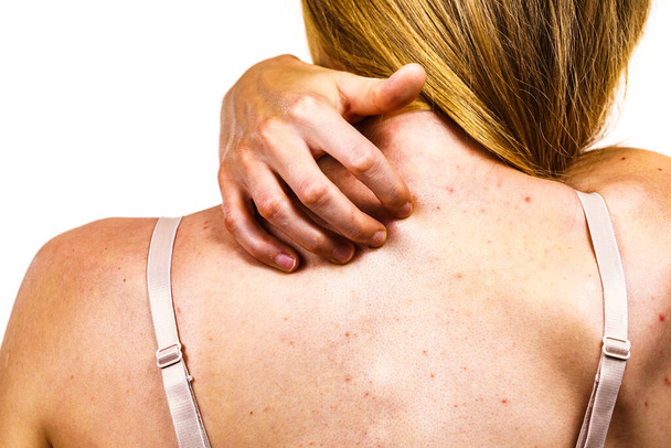 Health problem, skin diseases. Young woman showing her back with acne, red spots. Teen girl scratching her shoulder with pimples. - Foto, afbeelding