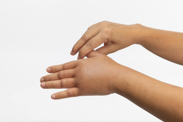 Gezwollen hand van allergische insectensteken. Huidallergische verzorging. - Foto, afbeelding