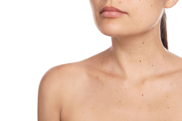 Closeup view of woman's body with birthmarks on white background - Фото, зображення