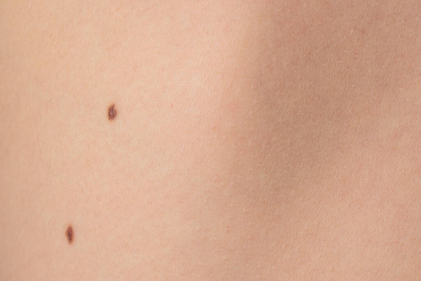 Brown warts on the child's body, the child's body and warts are brown. - Fotoğraf, Görsel