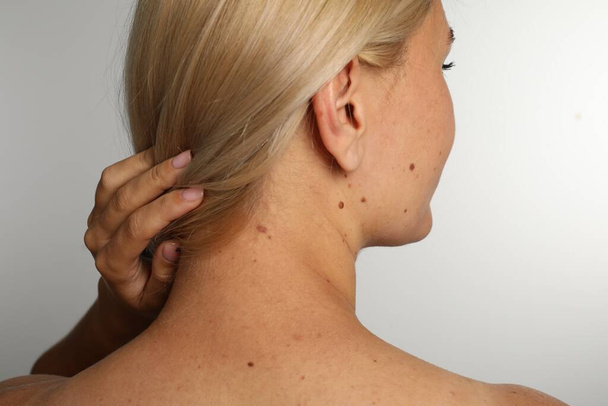 Woman with birthmarks on light grey background, back view - Foto, afbeelding