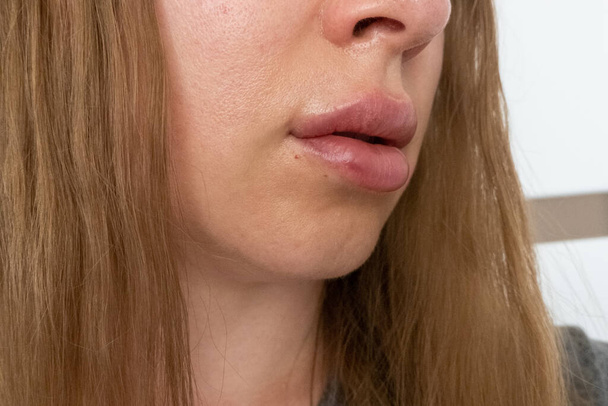 femme lèvres vue de près après la procédure d'augmentation des lèvres avec des charges, augmenter les lèvres acide hyaluronique, endroit visible des marques d'injection d'aiguille, gonflement après la procédure cosmétique, traitement cosmétique - Photo, image