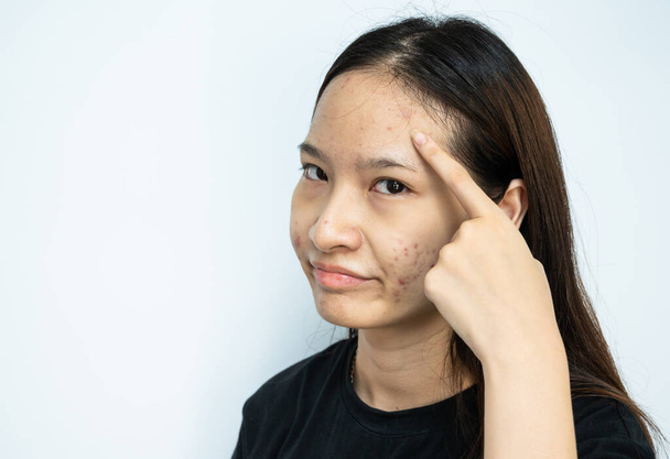 Femme asiatique pointant vers des problèmes d'acné enflammés sur son front. L'acné enflammée consiste en un gonflement, une rougeur et des pores profondément obstrués par des bactéries, de l'huile et des cellules mortes de la peau.. - Photo, image