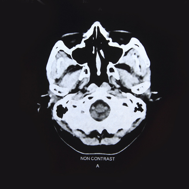 Beynin bilgisayarlı tomografisinden görüntüler - Fotoğraf, Görsel