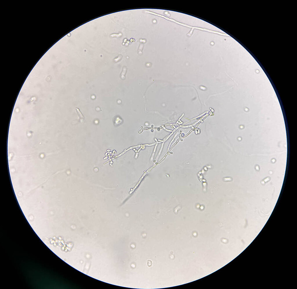Células de levadura en formación con pseudohifas en la muestra de orina hallazgo con microscopio 40X - Foto, imagen
