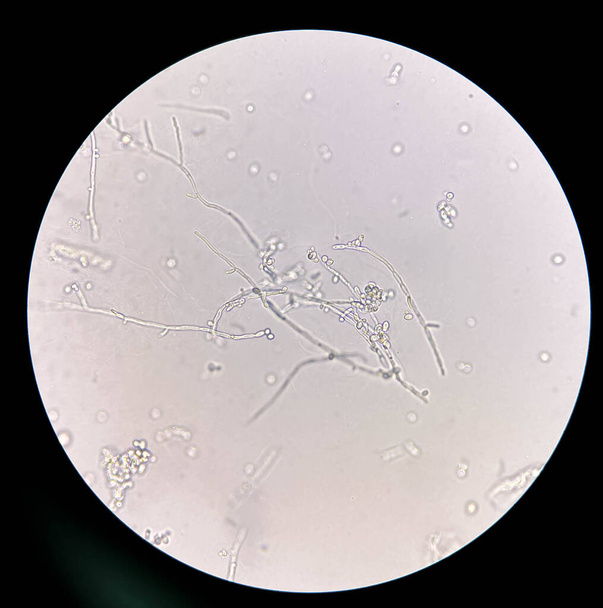 Células de levadura en formación con pseudohifas en la muestra de orina hallazgo con microscopio 40X - Foto, imagen