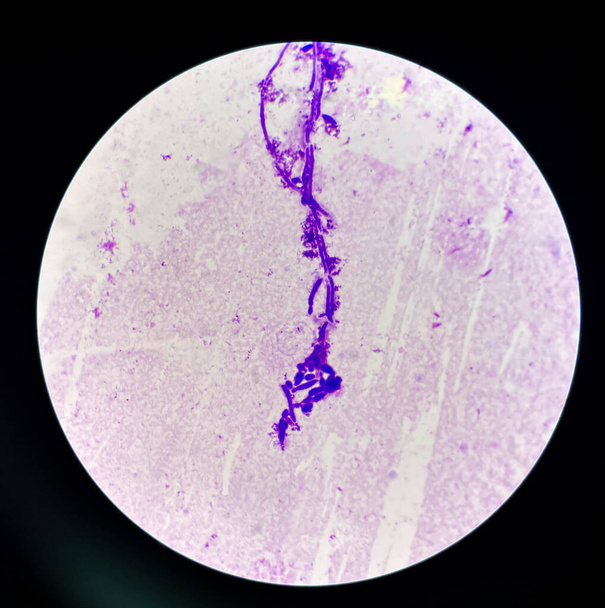 Cellule di lievito in germogliamento con pseudoife nel reperto di campioni di urina con microscopio 100X - Foto, immagini