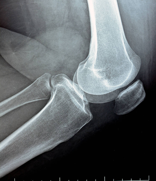 plain x ray on knee joint showing joint space narrowing and Subchondral Sclerosis on medial compartment (thickening of bone that happens in joints affected by osteoarthritis), knee osteoarthritis - Foto, afbeelding