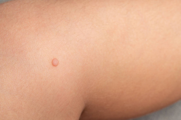 Common wart Verruca vulgaris on the skin of a child, papillomavirus in the body. - Foto, immagini