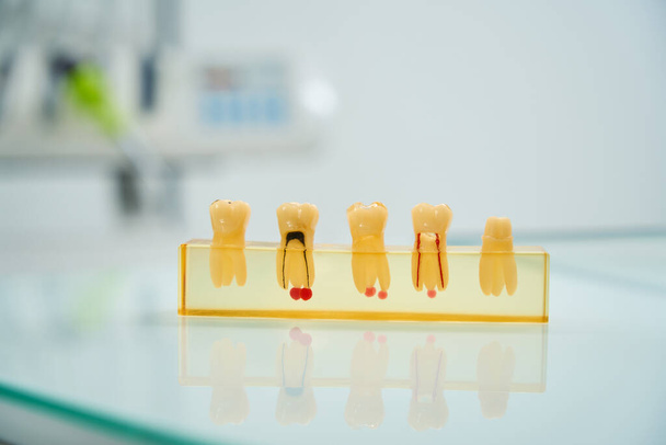 Фото моделей зубов с кариесом на прозрачной силиконовой подставке. Современная стоматологическая клиника - Фото, изображение