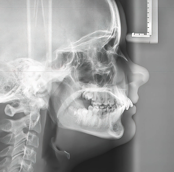 Radiographie latérale (téléradiographe) du crâne d'une jeune femme montrant un problème dans une palette et permettant une étude de la croissance faciale du patient et l'évaluation des dents par le dentiste - Photo, image