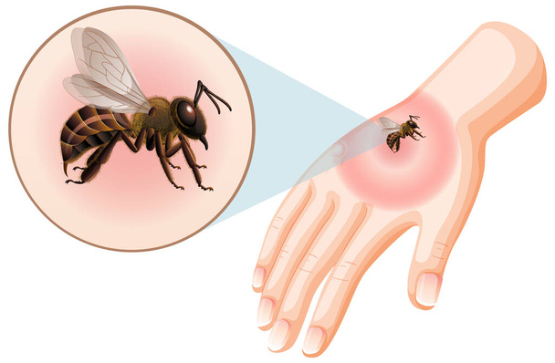 Pszczoła kąsa na skórze ilustracji - Wektor, obraz