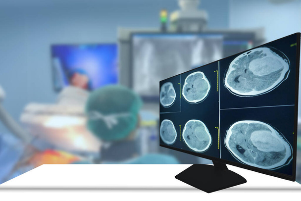 CTスキャン脳左前頭葉に不明確なマージンと周囲の浮腫を有する同位体質量を見つける。神経芽腫、脳転移。手術室の背景. - 写真・画像