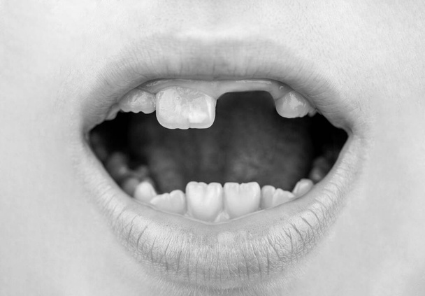 Близько до здорових молочних зубів. Дитячий пацієнт відкриває рот, що показує розпад зубів у порожнинах. Чорно-білий
. - Фото, зображення