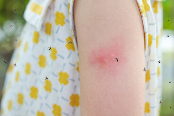 У маленькой девочки аллергия на сыпь на кожу, зуд и царапанье на руке комарами. - Фото, изображение