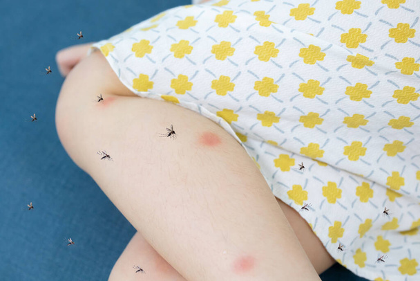 Little girl has skin rash allergy itching on her leg with mosquitoes bite - Fotó, kép