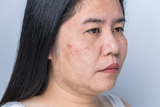 Asian adult woman face has freckles, large pores, blackhead pimple and scars problem from not take care for a long time. Skin problem face isolated white background. Treatment and Skincare concept - Foto, Bild