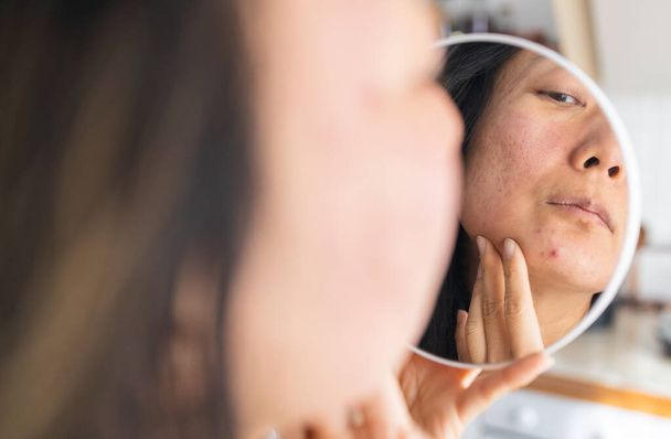 Dermatología, pubertad Mujer joven asiática, chica mirándose en el espejo, alergia que presenta una reacción alérgica de cosmética, mancha roja o erupción en la cara. Cuidado de la belleza del problema de la piel por tratamiento médico. - Foto, Imagen