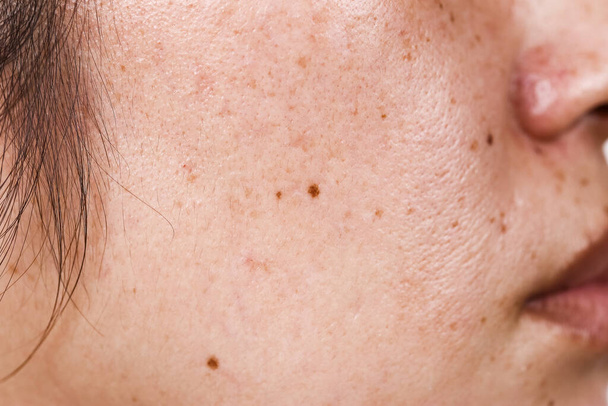 primer plano de la cara de la mujer con grandes poros puntos negros y pecas en la superficie de la cara - Foto, Imagen