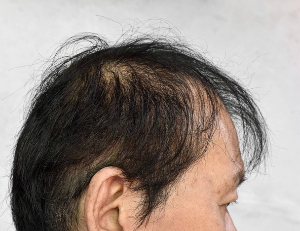 Thinning or sparse hair, male pattern hair loss in Southeast Asian, Chinese elder man. - Photo, Image