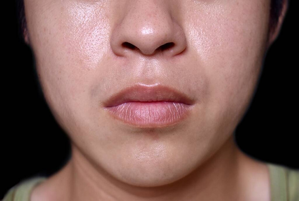 Oily face of Southeast Asian, Myanmar or Korean adult young man. - Fotó, kép