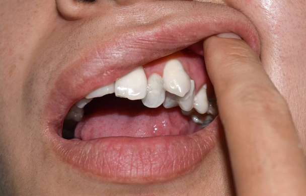 Ázsiai férfi halmozott vagy egymást átfedő fehér fogai. Más néven zsúfolt fogak.. - Fotó, kép
