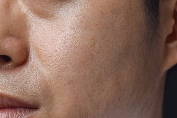 東南アジア、ミャンマー、韓国の成人男性の顔に広い毛穴を持つ公正な肌. - 写真・画像