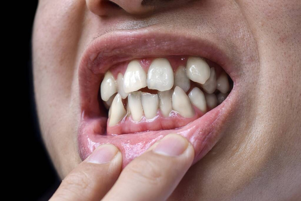 アジア人の白い歯を積み重ねたり重ねたり。混雑歯とも呼ばれる. - 写真・画像