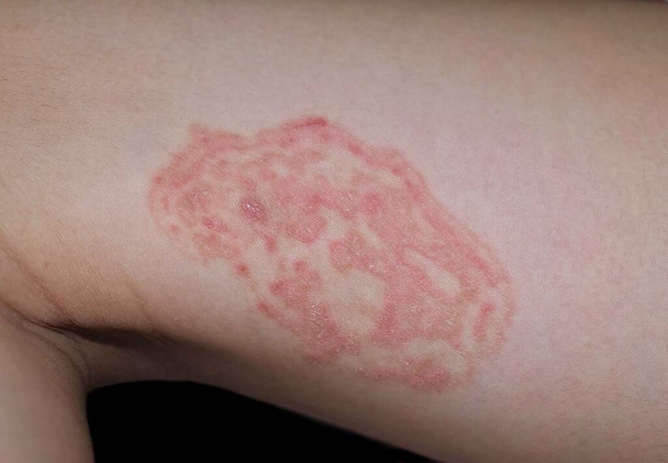 Gombás fertőzés, a tinea corporis a délkelet-ázsiai gyermek combjában. Gyűrűsféreg - Fotó, kép
