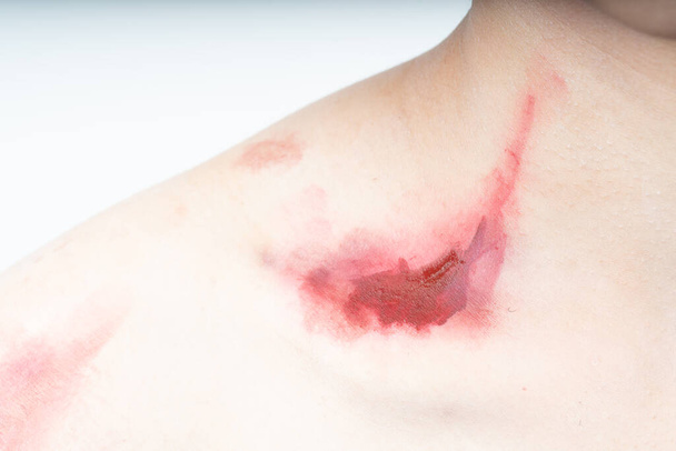 Sangre de piel humana lesionada - Foto, imagen