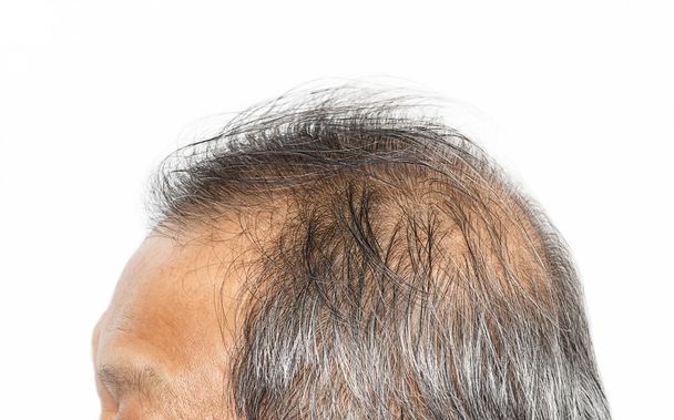 Pérdida de cabello, cabeza masculina con síntomas de pérdida de cabello
 - Foto, Imagen