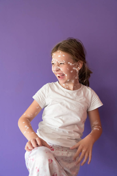 Portrait of a little school girl with chickenpox, antiseptic cream applied to face and body.Purple or violet background. High quality photo - Fotoğraf, Görsel