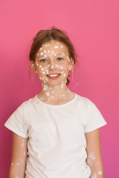 Portrait of a little school girl with chickenpox, antiseptic cream applied to face and body.Pink background. High quality photo - 写真・画像
