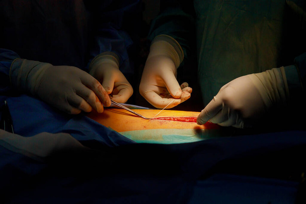 Een gewonde been wordt gerepareerd door een arts in de operatiekamer door het hechten van het wond - Foto, afbeelding