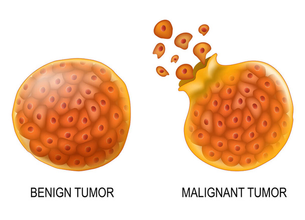 Cancer cells in Benign neoplasm and Malignant tumors. Close-up of carcinocytes that have the ability to metastasis (right). Cells of non-cancerous tumor are surrounded by a fibrous sheath of connective tissue (left). Vector poster - Vector, Image