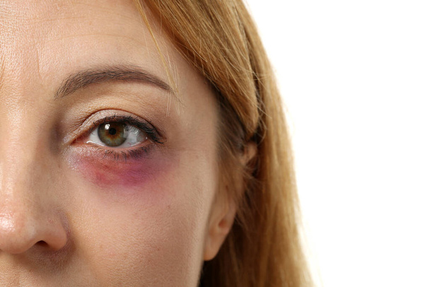 Mature woman with bruise under eye on white background, closeup - Φωτογραφία, εικόνα