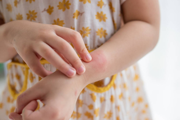 Little girl has skin rash allergy itching and scratching on her arm - Fotografie, Obrázek