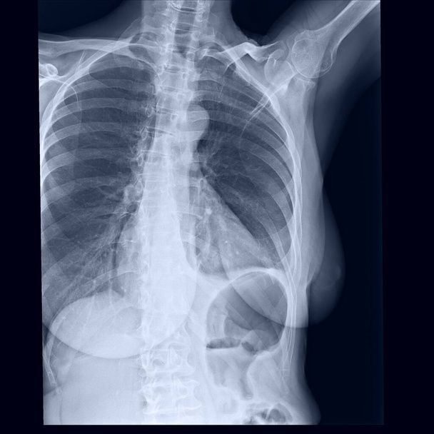 Raio-X da costa, esterno e clavícula mostrando violação da oitava costela à esquerda - Foto, Imagem