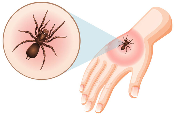 Piqûres d'araignée sur l'illustration de la peau - Vecteur, image
