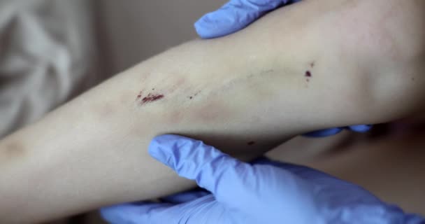 Lékař traumatolog zkoumá nohu dítěte s mnoha oděrky a hematomy detailní 4k film zpomalený film. Forenzní lékařská prohlídka v případě konceptu bití - Záběry, video
