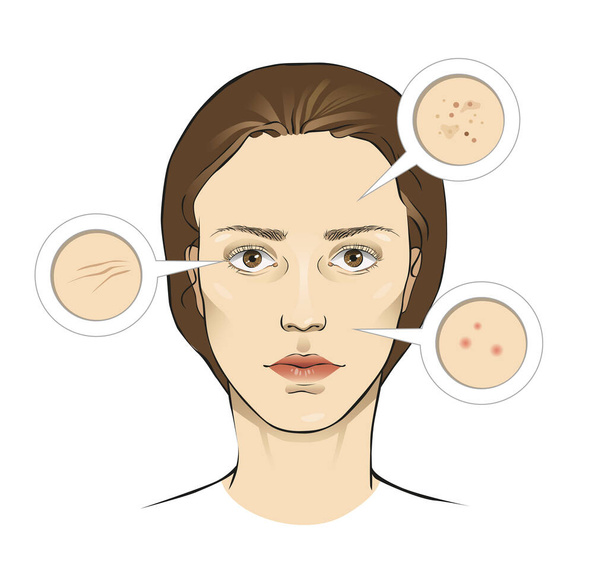 Illustrazione vettoriale dei problemi della pelle del viso della donna con primi piani: rughe, lentiggini, brufoli - Vettoriali, immagini