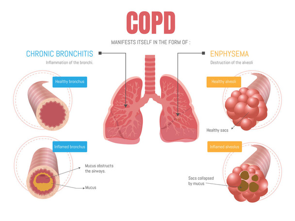 Epoc infografika: megnyilvánul két formában emphysema és bronchitis  - Vektor, kép