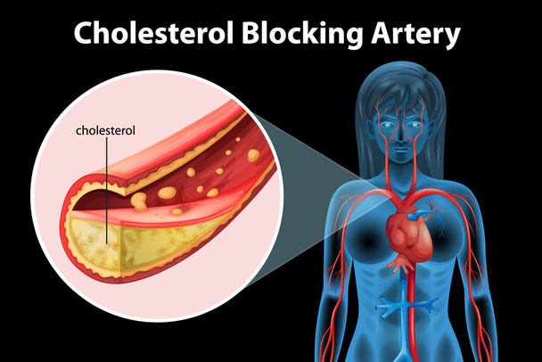 Ateriosclerosis - Vector, Image